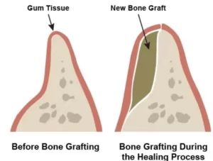 Reinforcing jaw with bone transplant