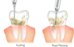Cleaning tools used for tooth surface