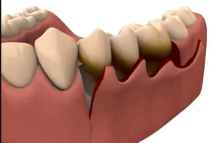 Surgical flap lifted to access root