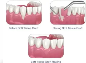 Tissue patch applied in mouth