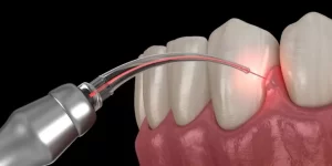 Laser used for gentle gum care