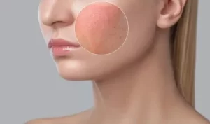 Red irritated skin with small bumps after using turmeric face mask.