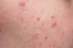 Face with visible acne scars and dark spots.