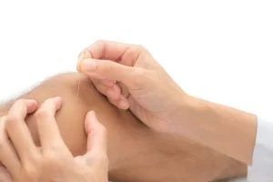 Acupuncture for arthritis pain relief and joint health improvement.