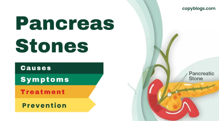 Pancreas stones showing causes, symptoms, treatment, and prevention.
